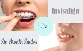 Jetzt kostenlosen termin in deiner nähe buchen Six Month Smiles Vs Invisalign Mission Hills Family Dental