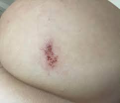The virus most probably entered through the genitals. Nsfw Hsv2 Outbreak On Butt Cheek Day Nine Someone Requested A Photo Of The Scabbing Healing Stage So Here It Is This Is With A Course Of 2 X 500mg
