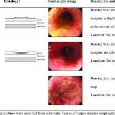 Cmv esophagitis usually affects immunosuppressed or immunodeficient people. Classifications Of Herpes Esophagitis Gross Appearance Vs Endoscopic Download Table
