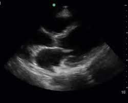 Inflammatory and endocrine causes picornavirus. Covid 19 And Point Of Care Echocardiography Clarius Mobile Health