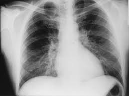 Image result for Q Fever