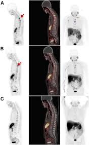 Be a sign of prostate, testicular, or urethral cancer. Prediction Of Psa Progression In Castration Resistant Prostate Cancer Based On Treatment Associated Change In Tumor Burden Quantified By 18f Fluorocholine Pet Ct Journal Of Nuclear Medicine