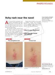 Pdf Itchy Rash Near The Navel