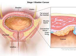 If bladder cancer is found, certain features of the cancer cells help the doctor know how best to treat it: Treatment May Help Prevent Bladder Cancer Recurrences National Cancer Institute