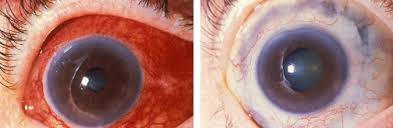 Image result for lesion sclera