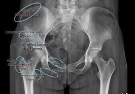 The team used the six generic headings to prompt ideas. Pelvic Apophyseal Avulsion Fractures Diagram Radiology Case Radiopaedia Org