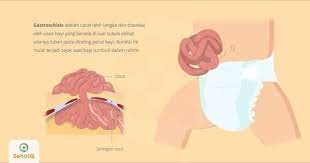 Gastroschisis Adalah Cacat Lahir Langka Dan Ditandai Dengan Usus Bayi Berada Di Luar Tubuh Akibat Adanya Lubang Pada Dinding Perut Bay Tubuh Kelahiran Penyakit