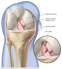 A partial acl tear is an incomplete tear or injury to the anterior cruciate ligament (acl). Acl Injury Mayo Clinic