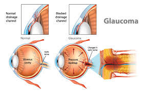 Image result for Intraocular Pressure