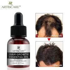 A study of 86 patients diagnosed with alopecia areata (an autoimmune disease that can cause hair loss) discovered that a mix of essential oils, including. Artiscare Hair Growth Essential Oil Hair Care Treatment For Men And Women Hair Loss Essence Liquid Repair Hair Root 20ml Hair Loss Products Aliexpress