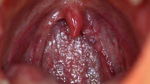 Image result for human papillomavirus symptoms