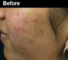 After your laser hair removal treatment it is normal to experience redness and swelling in the treatment area following laser hair removal. Laser Hair Removal Before And After Pictures Wifh