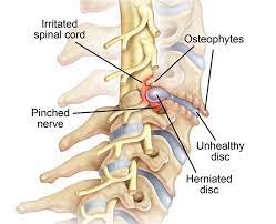 Many of the treatments for cervical spondylosis have not been subjected to rigorous, controlled trials.6 surgery is advocated for cervical commonly, osteophytes and portions of intervertebral disc are removed.8. Cervical Radiculopathy Causes Symptoms And Treatment