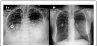 Breast cancer symptoms, signs of breast cancer, triple negative breast cancer, breast cancer stages what does breast cancer look like? P A Chest X Ray Images Of The Patient With Breast Cancer A Before Download Scientific Diagram
