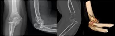 Image result for Radial Head Dislocation