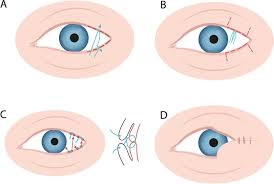 Image result for lesion sclera
