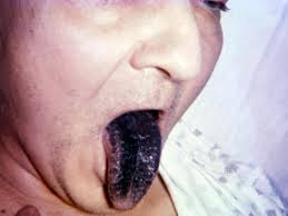 Image result for black hairy tongue symptoms