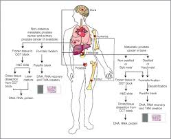 But hearing the words can still be scary. Characterization Of Bone Metastases From Rapid Autopsies Of Prostate Cancer Patients Clinical Cancer Research