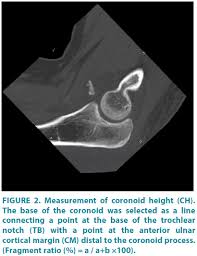 Image result for Coronoid Process Fracture