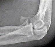 Image result for Coronoid Process Fracture