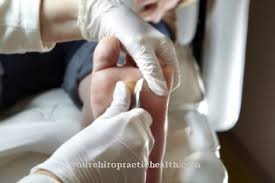 Posljedica su povećanog pritiska na kožu. Kukuruz Uzroci Simptomi I Lijecenje Bolesti