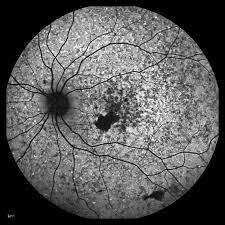 Name Mara Goldberg Cra Description Ophthalmology Ophthalmicphotography Autofluorescence Retina Stargardt S Disease Medical Art Optometry Eye Health