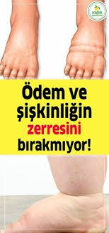 Odem Ve Siskinligin Zerresini Birakmiyor Saglik Odem Siskinlik Kilo Health Detox Health Detoxify Your Body