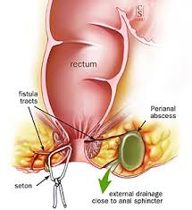 When boils are large, complications can occur that could be harmful to your health. Natural Remedy For Fistula And Perianal Abscess Listen To Your Gut