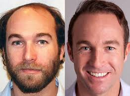 Restauración del cabello: "He recuperado mi pelo natural"