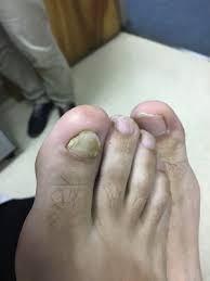 Image result for Onychotillomania feet