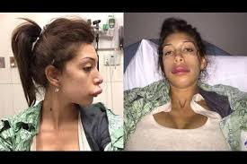 Plastic surgeries are becoming more and more common throughout the country. Pictures Bad Celebrity Plastic Surgery Orlando Sentinel