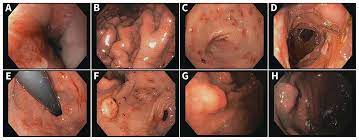 Zollinger–Ellison syndrome | CMAJ