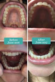 Smile Direct Club Before And After Smiledirectclub Smile Direct Dental Braces