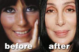 Plastic surgeries are becoming more and more common throughout the country. Celebrity Cher Plastic Surgery Before And After Http Www Celeb Surgery Com Celebrity Cher Plastic Surgery Before And After Pinterest Cirugias Plasticas