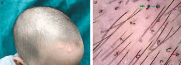 Image result for Tinea Capitis