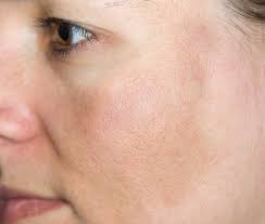 Pigmentary Disorders Manchester, Cheshire & Lancashire | Dr Nicole  Dermatology