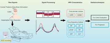 Image result for Thalamic Stimulation