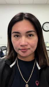 Peeling time #oskinmedspa #oliviaquidoskincare