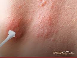 Image result for Hives