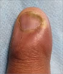 Image result for Onychotillomania feet