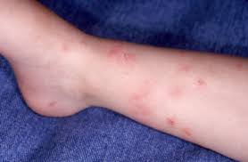 Bites That Look Like Bed Bug Bites But Aren T What Bit Me Spot These 12 Summer Bug Bites Fleas Bed Bug Bites Flea And Tick