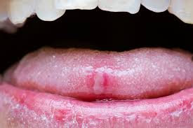 We did not find results for: What Causes Canker Sores The New York Times
