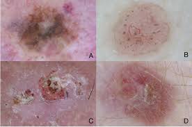 The most important sign of potential melanoma is a change in the skin's appearance, such as a change in an existing mole, or, more importantly, the appearance of a new spot. Classic Dermoscopy Improves The Early Diagnosis Of Melanoma And Download Scientific Diagram