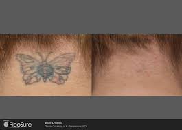 With tattoo removal green bay, you can be confident in your skin again! Picosure Tattoo Removal