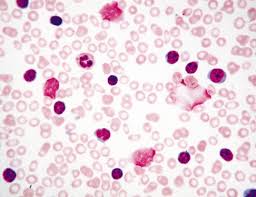 Drop a blood, save a life. Smudge Cells Artifacts Or Clinically Significant Lablogatory