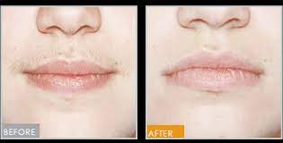 Columbus institute of plastic surgery offers laser hair removal treatments to permanently reduce unwanted body hair for clients at their columbus medical facility. Laser Hair Removal Columbus Aesthetic Plastic Surgery