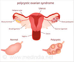 Conventional treatment of pcos includes a range of oral pharmacological. Test Your Knowledge On Polycystic Ovarian Syndrome Pcos