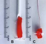 Single Angio-Seal vascular closure device for transfemoral ...