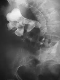 When the procedure is complete, the surgeon may leave drainage tubes in the kidney. Staghorn Kidney Stone Doccheck