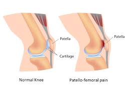 Knee Pain In Runners New Theories On Patellofemoral Pain Syndrome Canadian Running Magazine